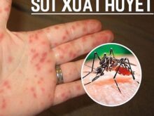 Dịch sốt xuất huyết mùa mưa - Triệu chứng, phòng tránh hiệu quả